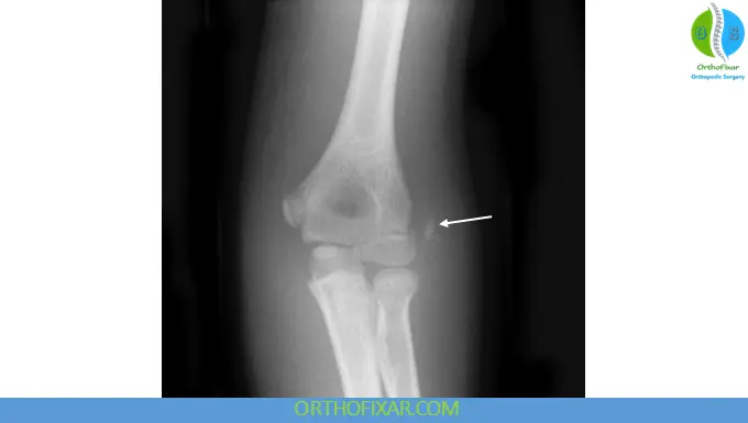 Lateral Humeral Epicondyle Fractures 5 lateral epicondyle fracture