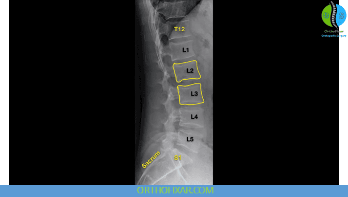 Lumbar Spine X-Ray Views 2 lateral lumbar X-ray