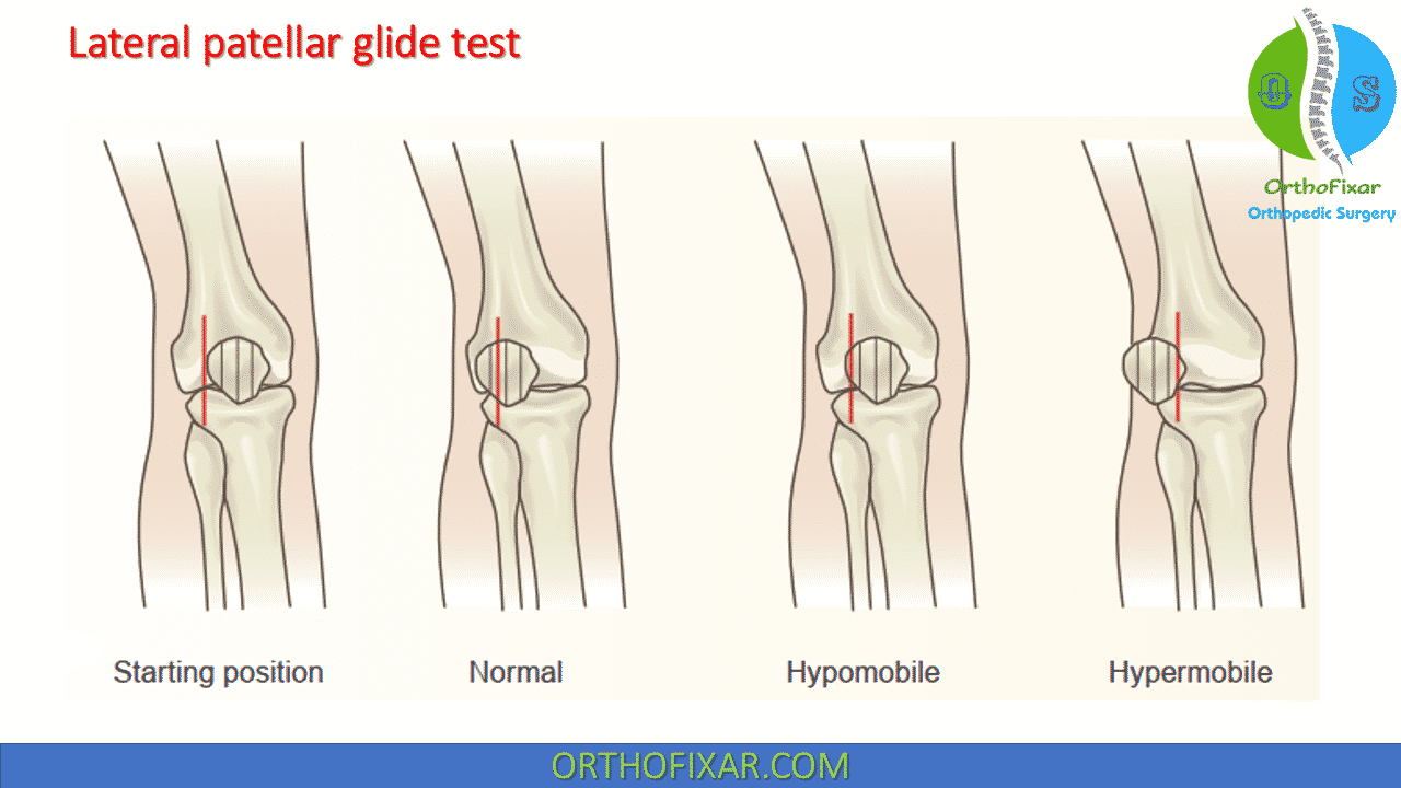 Example of patellar orientation with a lateral glide and/or tilt