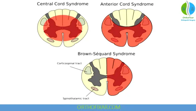 lesions of spinal cords