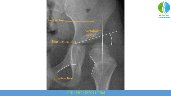 Hip Joint X-Ray Imaging 2 lines on hip xray