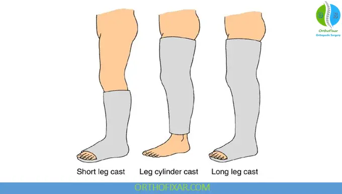 Fracture Casting: Principles, Techniques & Complications 7 lower limb casting
