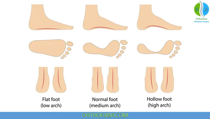 medial Arch Types