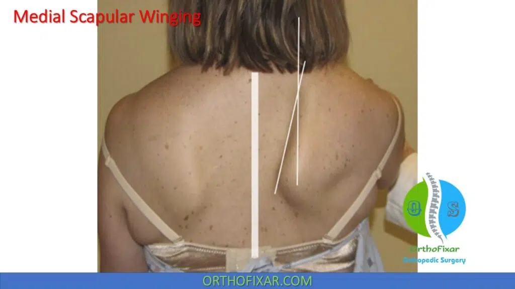 Scapular Winging Test 3 medial Scapular Winging