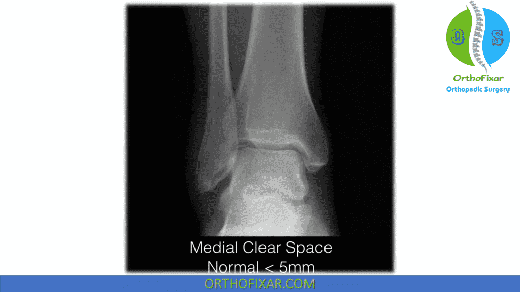 medial clear space ankle xray