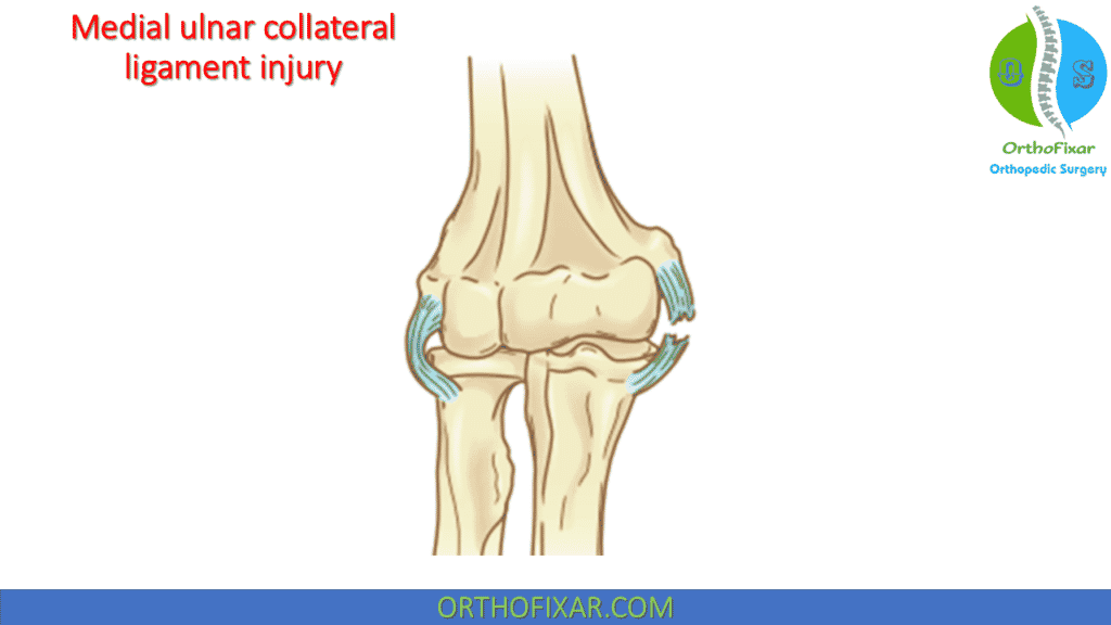 medial ulnar collateral ligament injury
