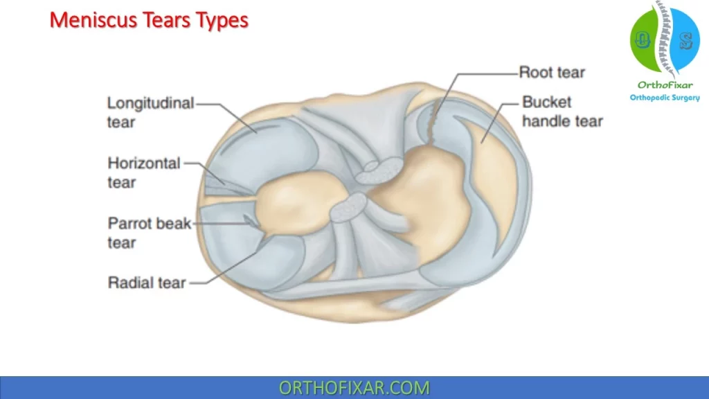 meniscus tear types
