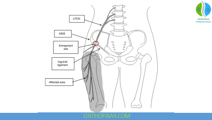 Meralgia Paresthetica Overview 2 meralgia paresthetica compression test