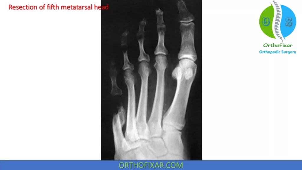 metatarsal head resection