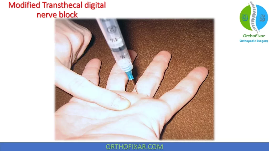 modified Transthecal digital nerve block