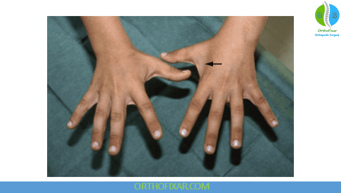 Guyon Canal Syndrome Overview 3 motor deficits due to compression inside the Guyon Canal
