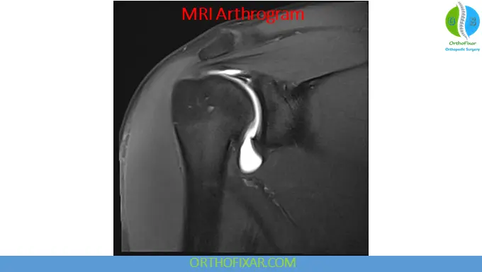 Arthrography: Indications, Technique, Uses & Interpretation 6 mri arthrogram