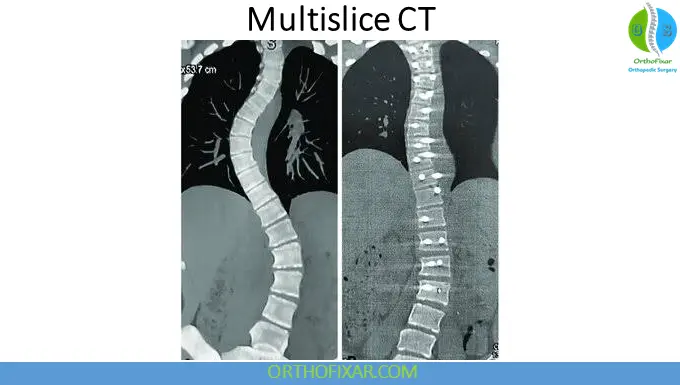multislice CT scan