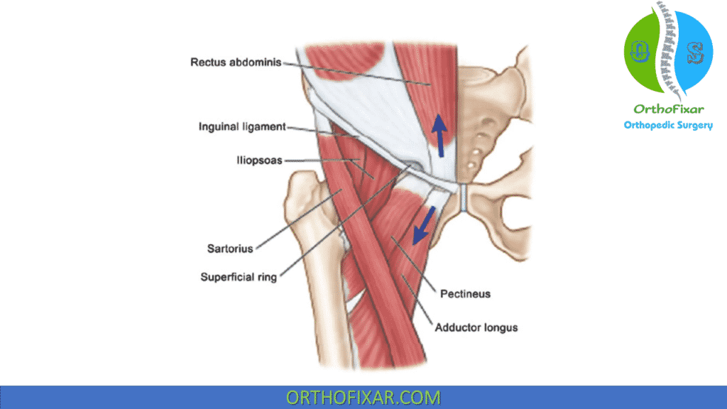 abdominal sports hernia