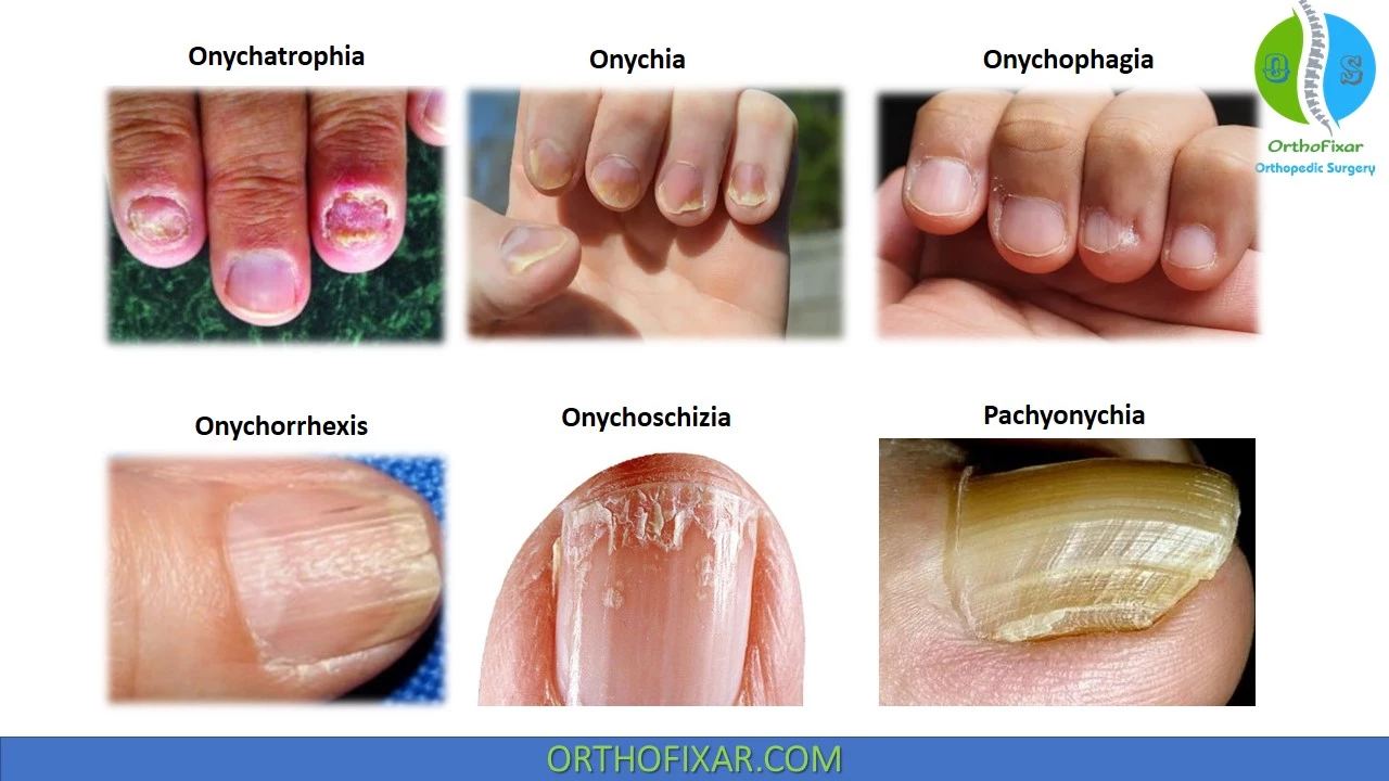 nail deformities types
