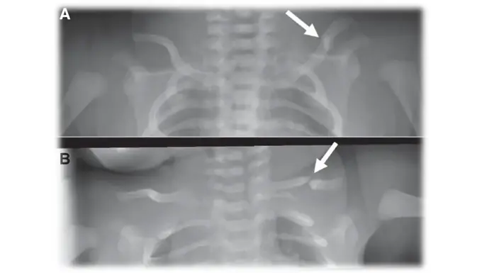 newborn broken fracture xray