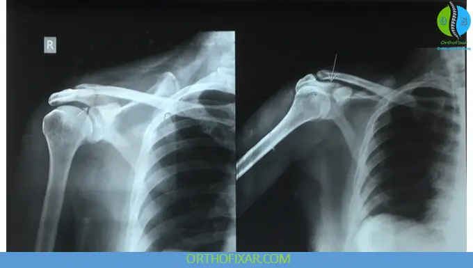 Acromial Fractures: Diagnosis, Classification & Treatment 6 none-displaced Acromial Fracture