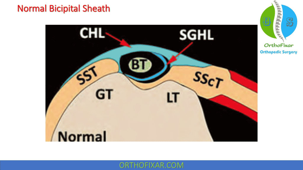 normal bicipital sheath