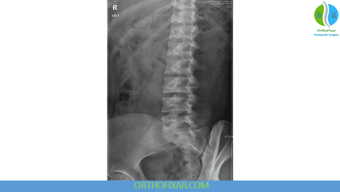 Lumbar Spine X-Ray Views 3 oblique lumbar X-ray