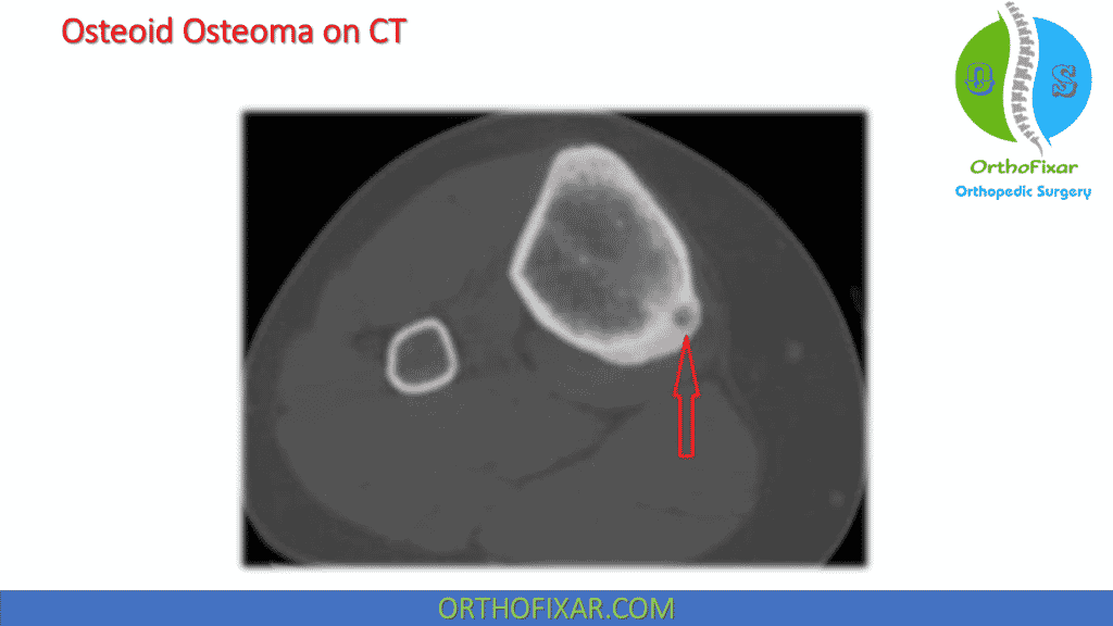 Osteoid Osteoma CT