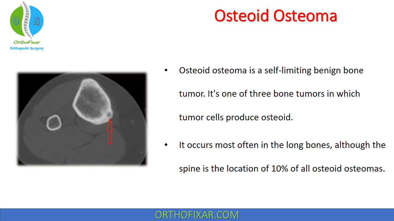 Osteoid Osteoma
