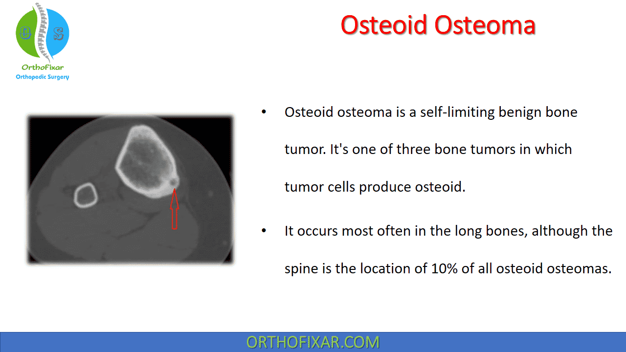 symptoms of osteoma