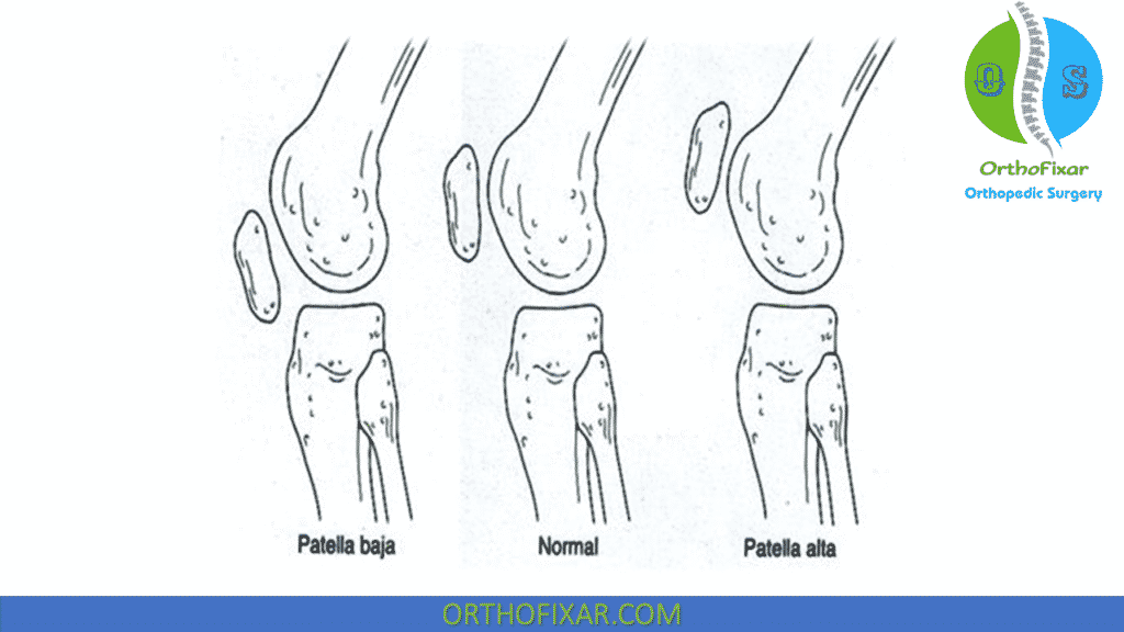 patella positions deformity