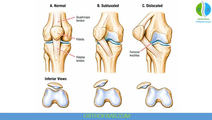 patellar dilocation types
