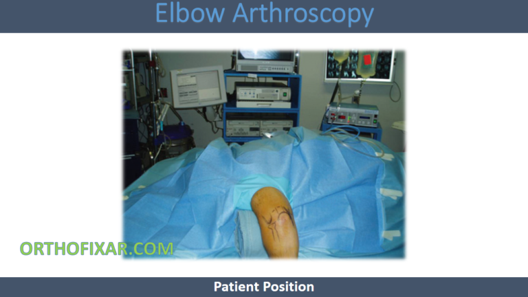 Elbow Arthroscopy • Easy Tutorial • Orthofixar 2026 