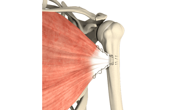 Pectoralis Major Repair: What Patients Need to Know 2 pec major tendon repair