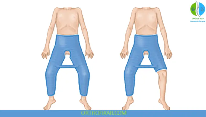 pediatric femoral shaft fractures Spica Casting