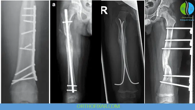 pediatric femoral shaft fractures fixation options