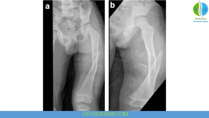 pediatric femoral shaft fractures xray