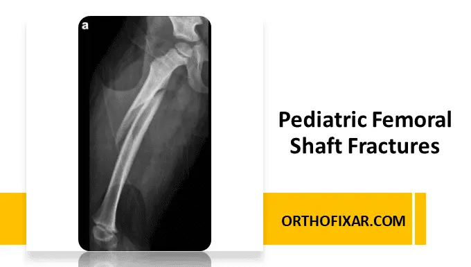 pediatric femoral shaft fractures