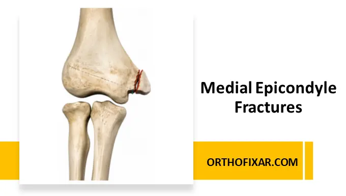 pediatric medial epicondyle fractures