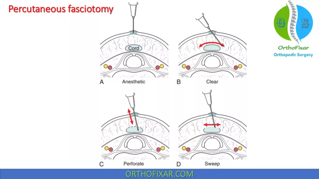 percutaneous fasciotomy of Dupuytren Contracture