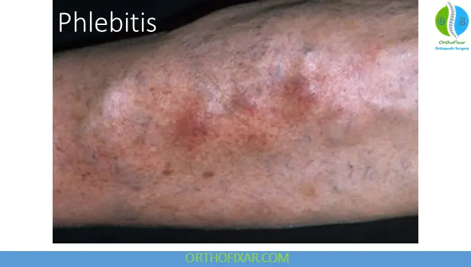 Phlebitis: Causes, Symptoms, Diagnosis & Treatment 4 phlebitis signs