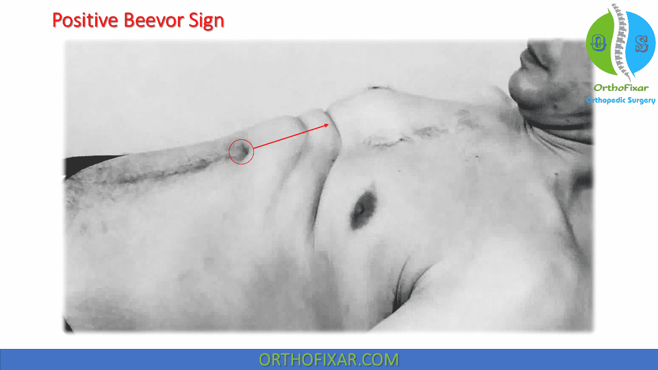 Beevor Sign: Clinical Test For Rectus Abdominis Weakness And Spinal ...
