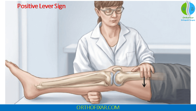 Lelli Test (Lever Sign Test) 2 positive Lelli Test (Lever Sign Test)