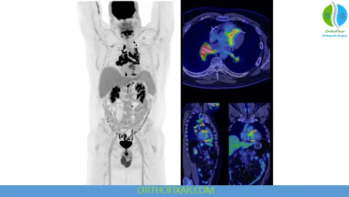 positron emission tomography