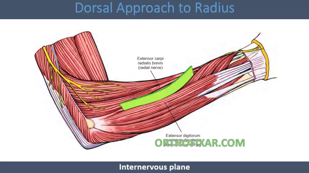 posterior approach to radius Internervous Plane