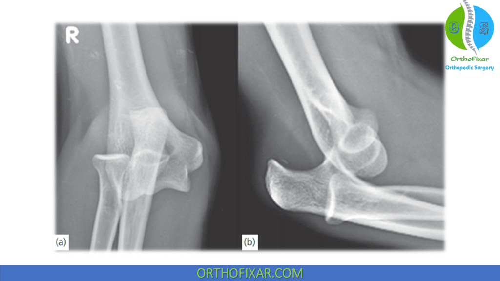 posterior elbow dislocation