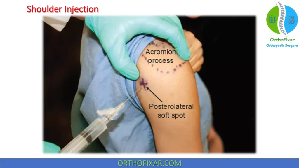 subacromial injection