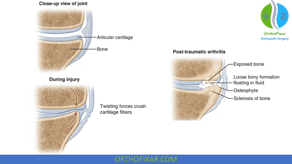 progression of posttraumatic AC joint osteoarthritis