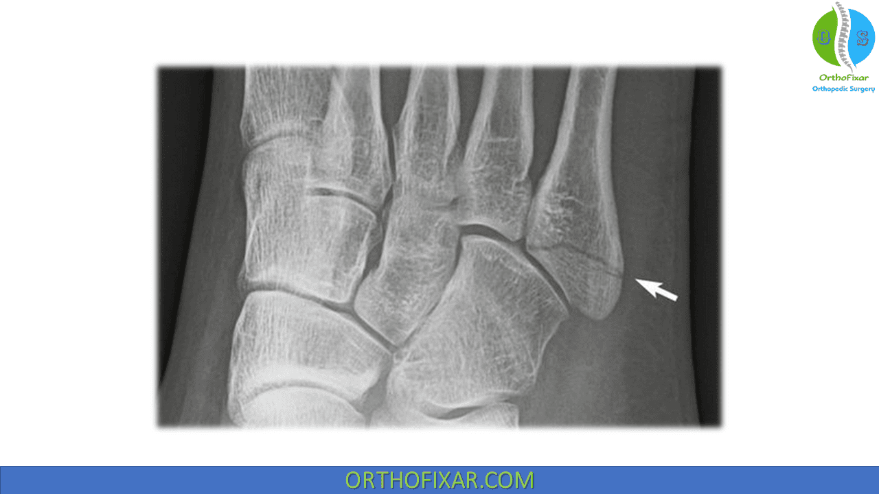 5th Metatarsal Fracture OrthoFixar 2024