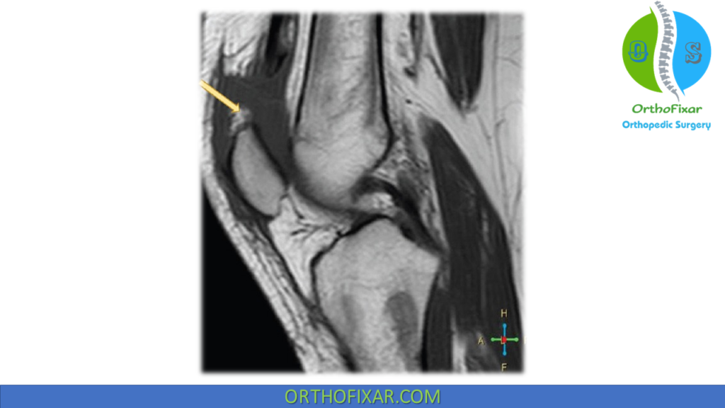 Quadriceps Tendon Mri