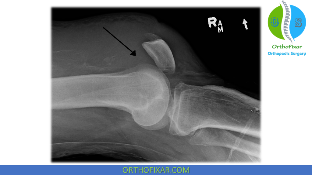 quad tendon rupture xray