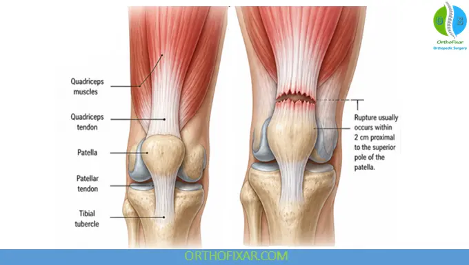 quad tendon rupture