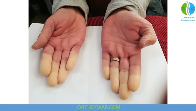 Raynaud's Phenomenon: Causes, Symptoms, Diagnosis & Treatment 5 raynaud's phenomenon symptoms