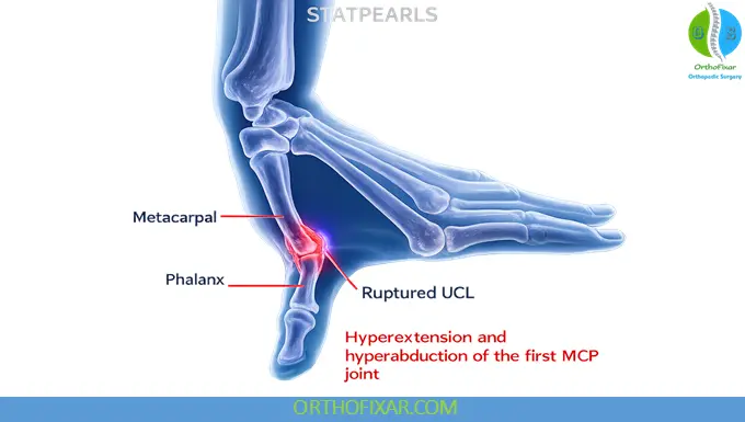 ruptured ulnar collateral ligament - Skier’s Thumb
